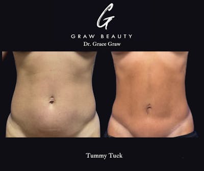 Abdominoplasty Before & After Gallery - Patient 348101 - Image 1