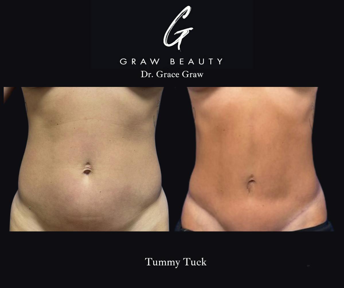 Abdominoplasty Before & After Gallery - Patient 348101 - Image 1