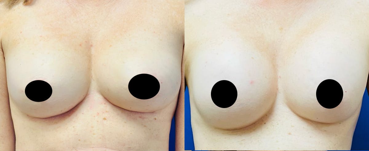 Fat Grafting Before & After Gallery - Patient 285906 - Image 1