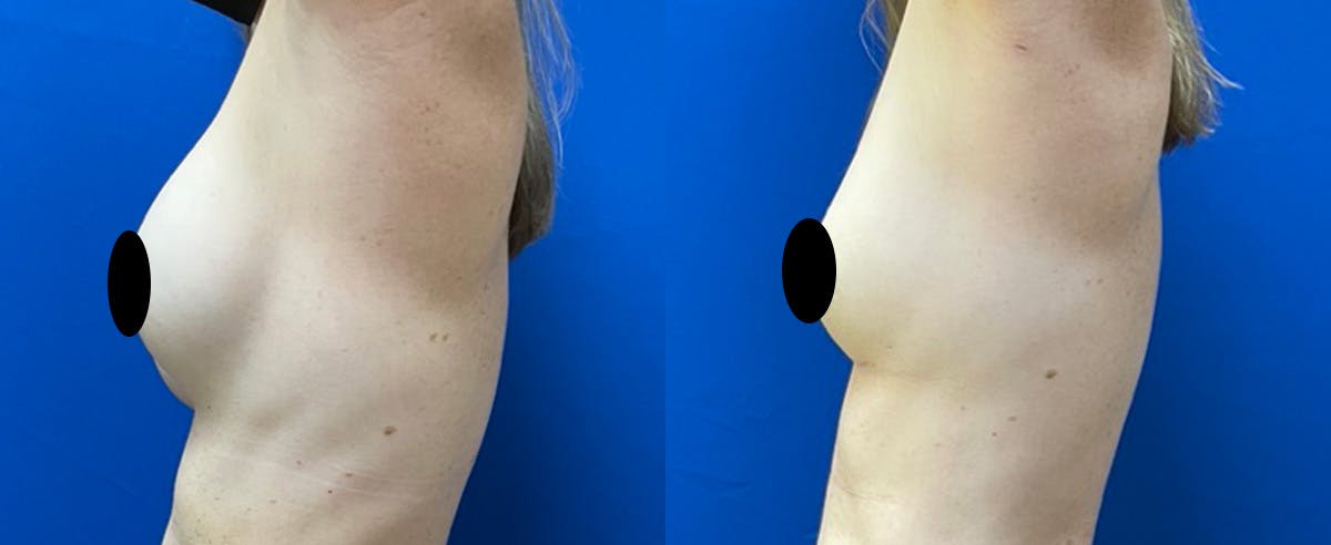 Fat Grafting Before & After Gallery - Patient 285906 - Image 4