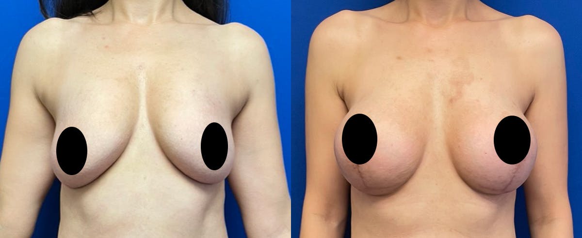 Breast Lift Before & After Gallery - Patient 208537 - Image 1