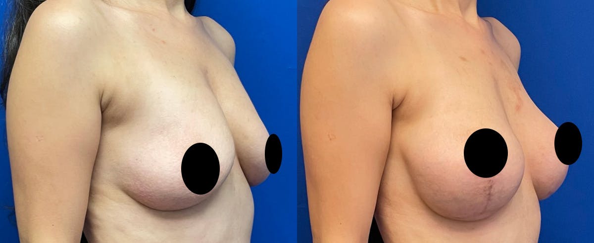 Breast Lift Before & After Gallery - Patient 208537 - Image 2