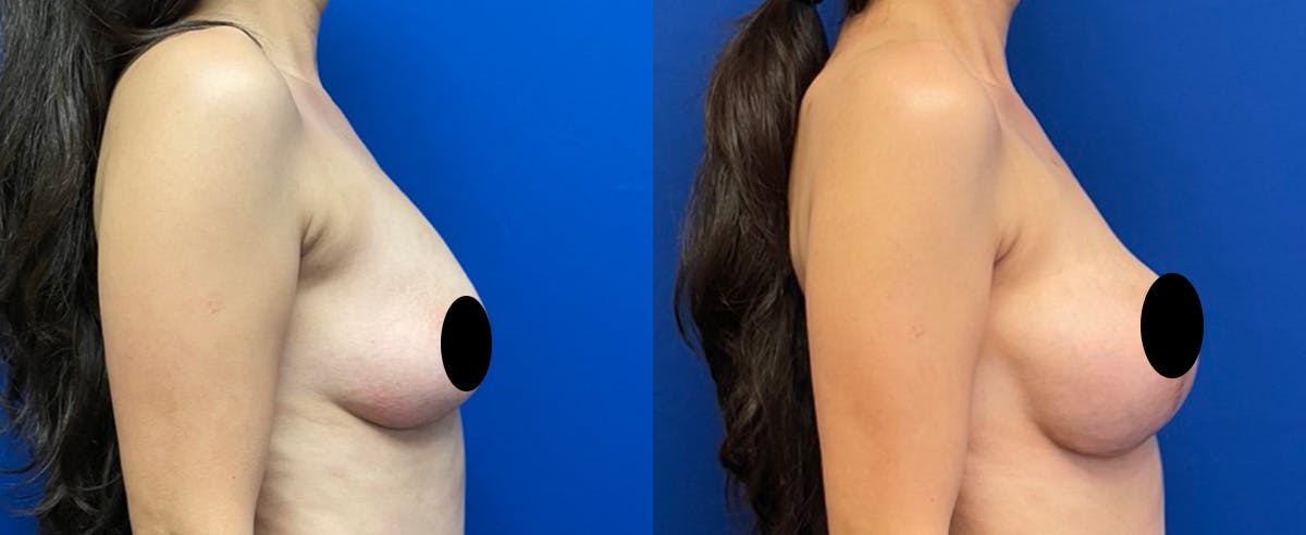 Breast Lift Before & After Gallery - Patient 208537 - Image 3