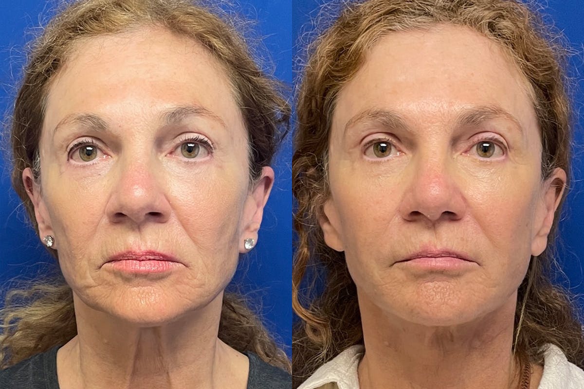 Neck Lift Before & After Gallery - Patient 917643 - Image 1