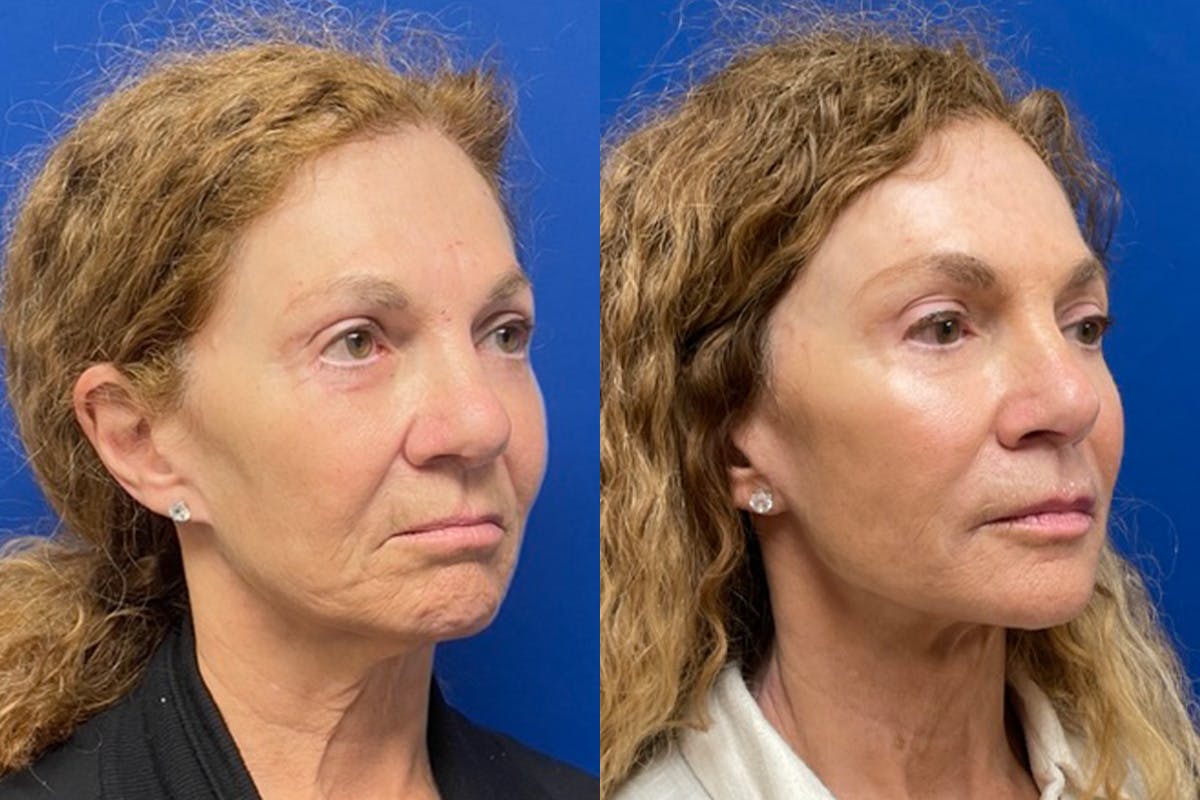 Neck Lift Before & After Gallery - Patient 917643 - Image 2