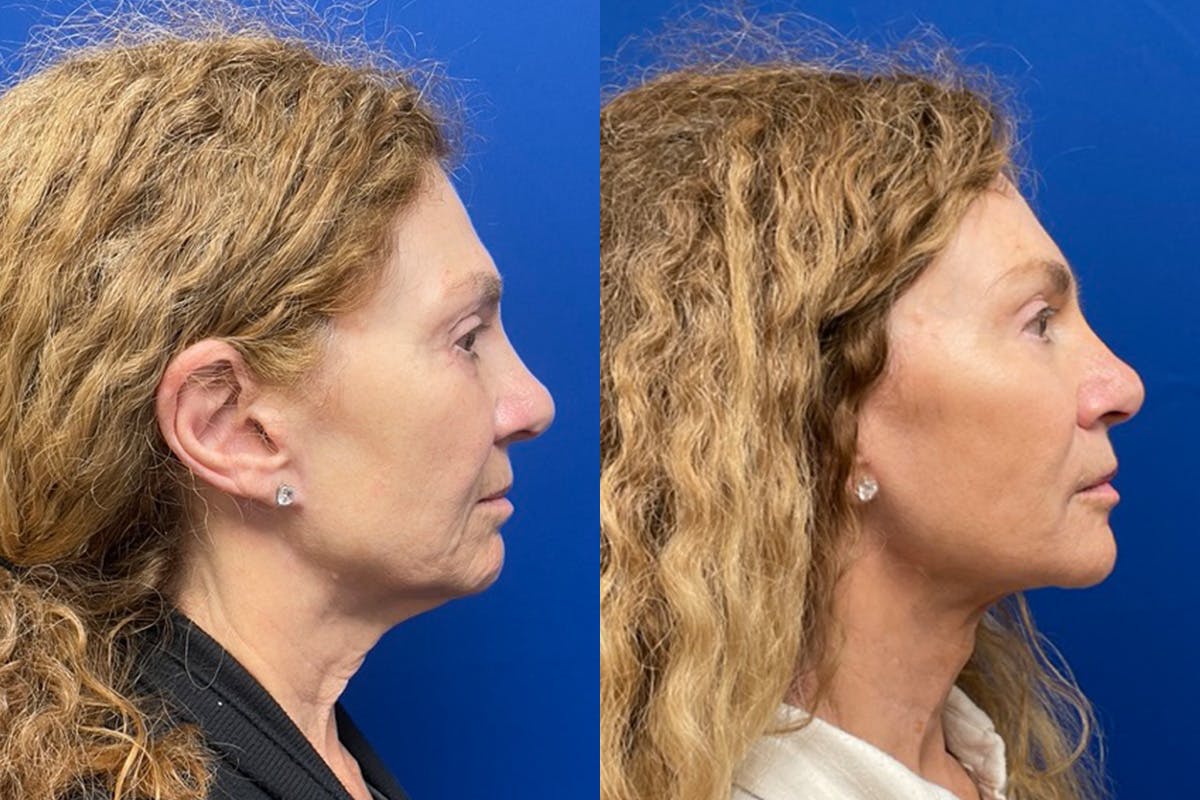 Neck Lift Before & After Gallery - Patient 917643 - Image 3