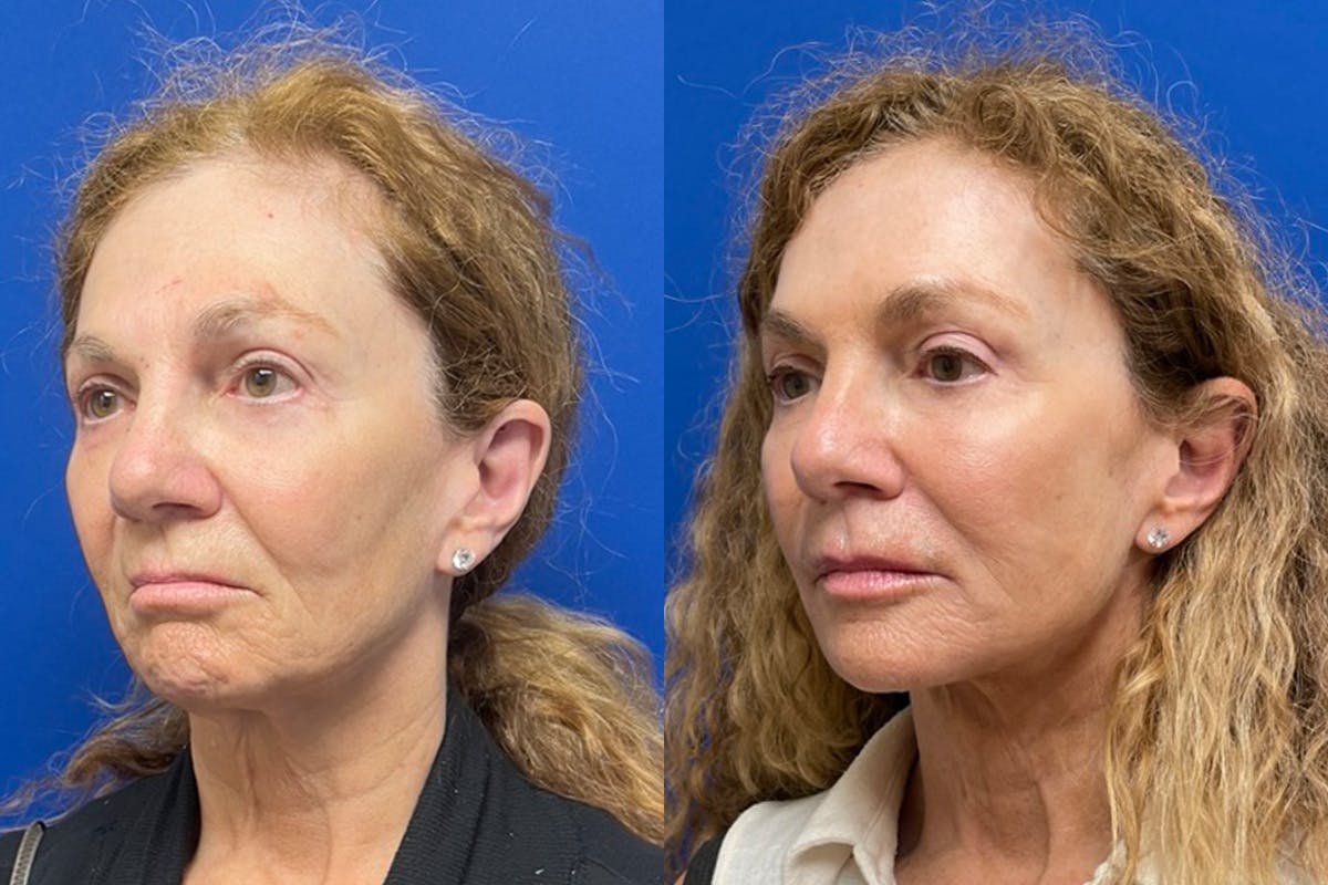 Neck Lift Before & After Gallery - Patient 917643 - Image 4