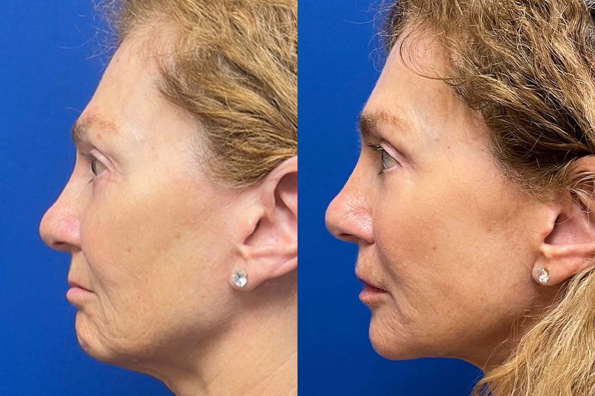 Neck Lift Before & After Gallery - Patient 917643 - Image 5