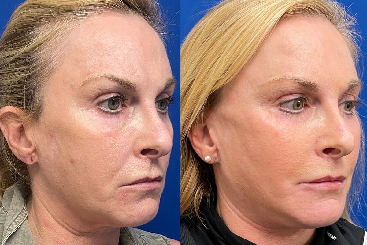 Facelift Before & After Gallery - Patient 294590 - Image 2