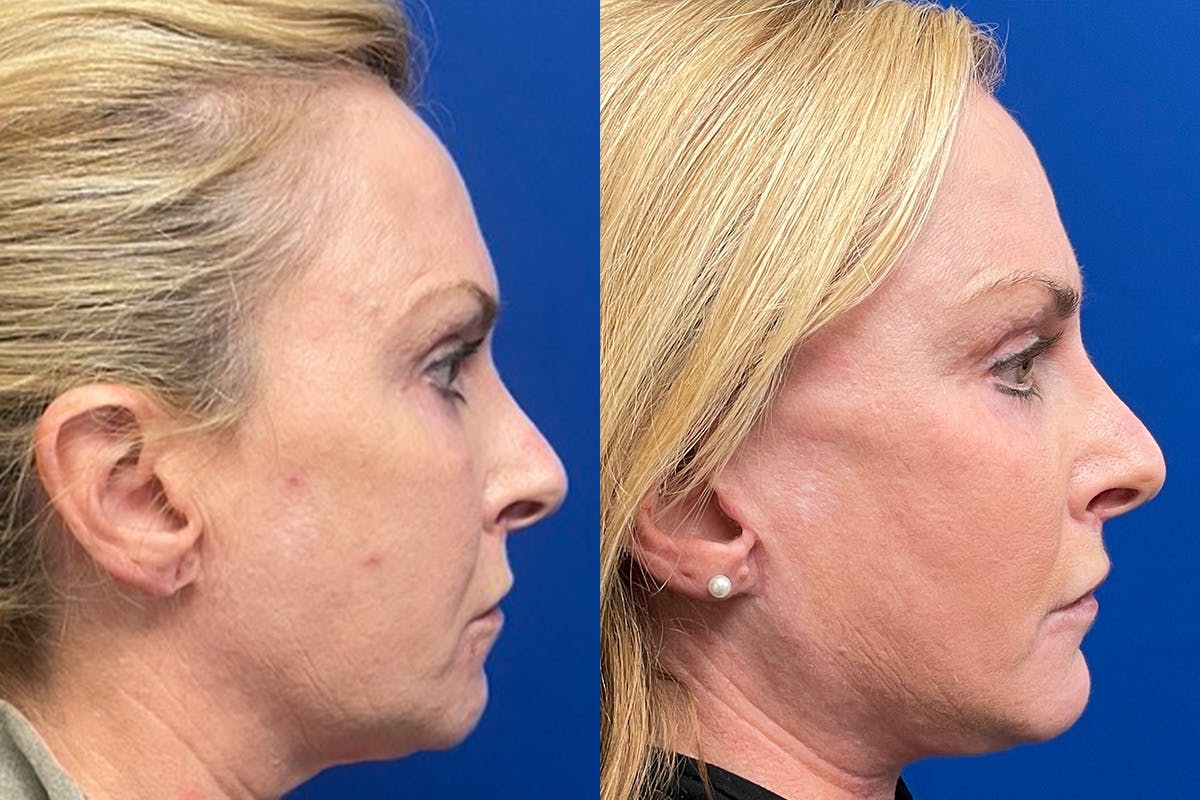 Facelift Before & After Gallery - Patient 294590 - Image 3