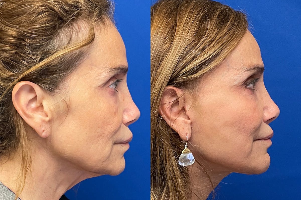 Neck Lift Before & After Gallery - Patient 222421 - Image 2