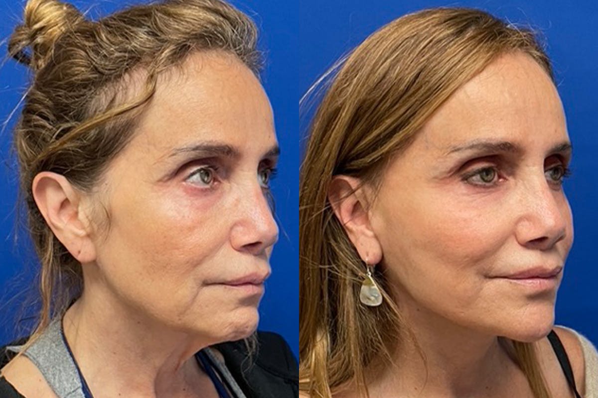 Neck Lift Before & After Gallery - Patient 222421 - Image 1