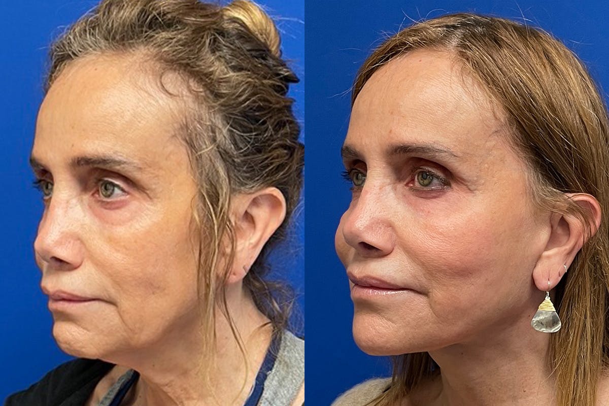 Neck Lift Before & After Gallery - Patient 222421 - Image 3