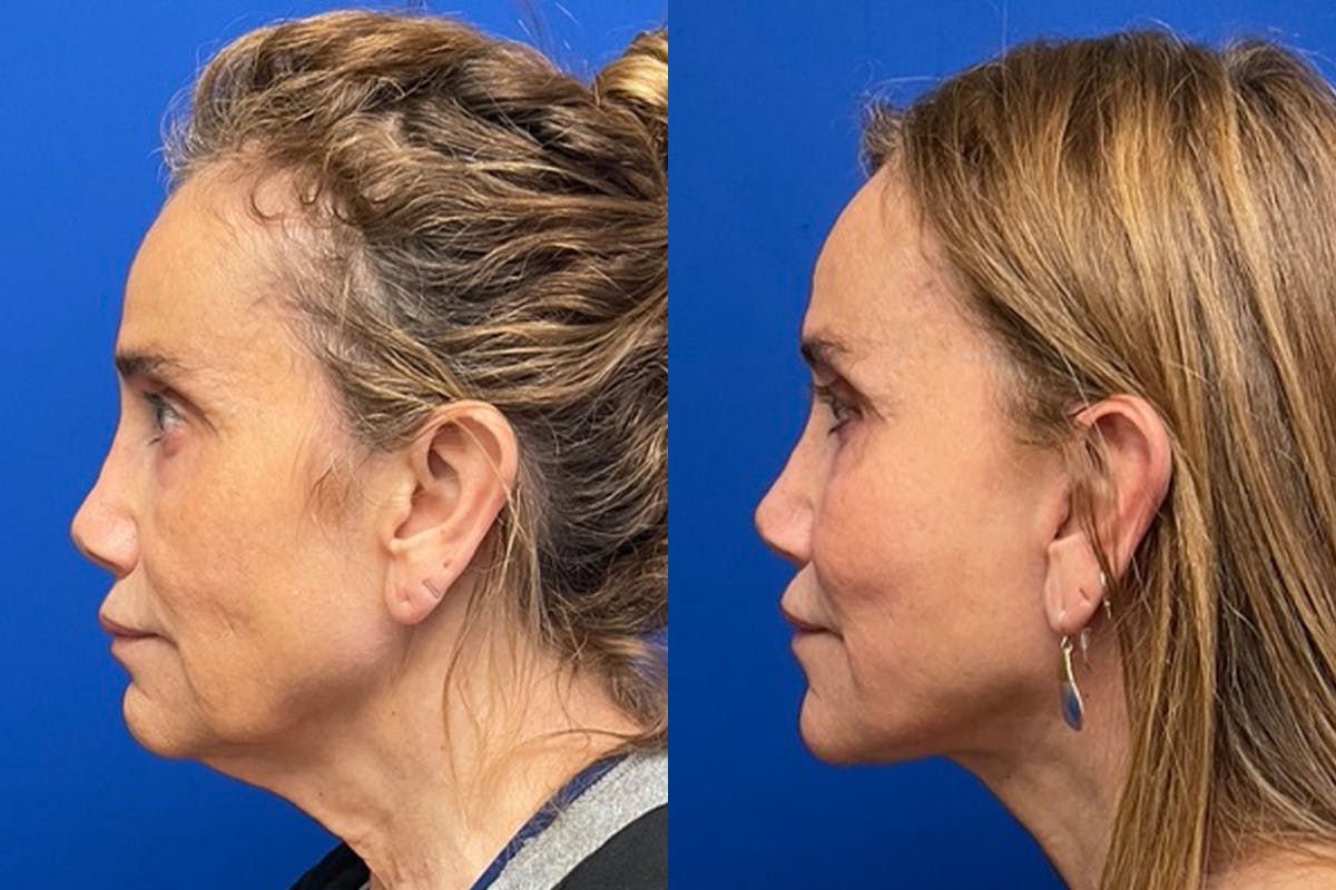 Neck Lift Before & After Gallery - Patient 222421 - Image 4