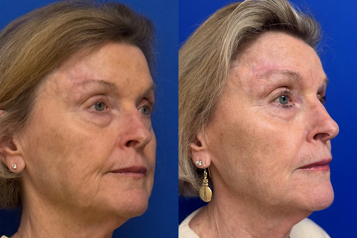 Facial Contouring / Submental Lipo Before & After Gallery - Patient 630859 - Image 2