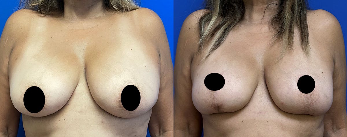 Fat Grafting Before & After Gallery - Patient 226661 - Image 1