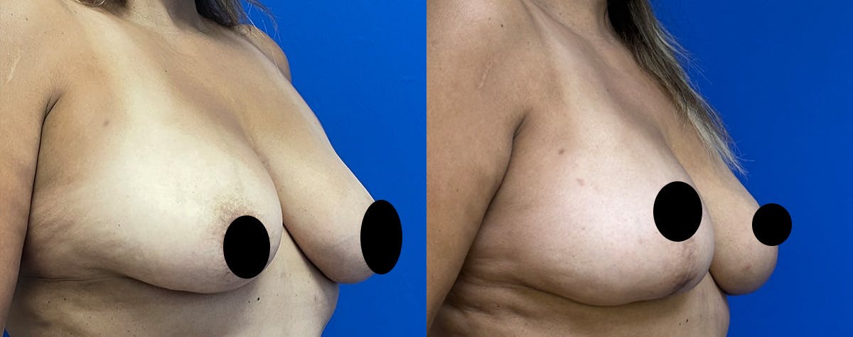 Fat Grafting Before & After Gallery - Patient 226661 - Image 2