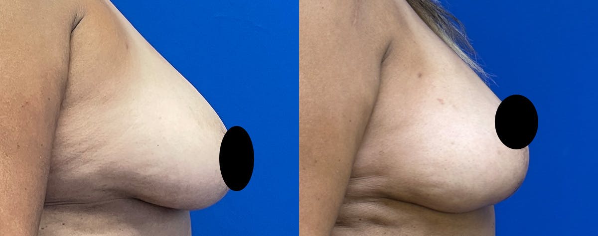 Fat Grafting Before & After Gallery - Patient 226661 - Image 3