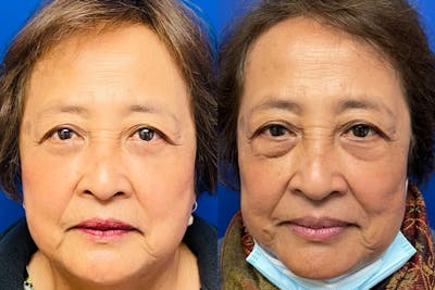 Eyelids Before & After Gallery - Patient 140792 - Image 1