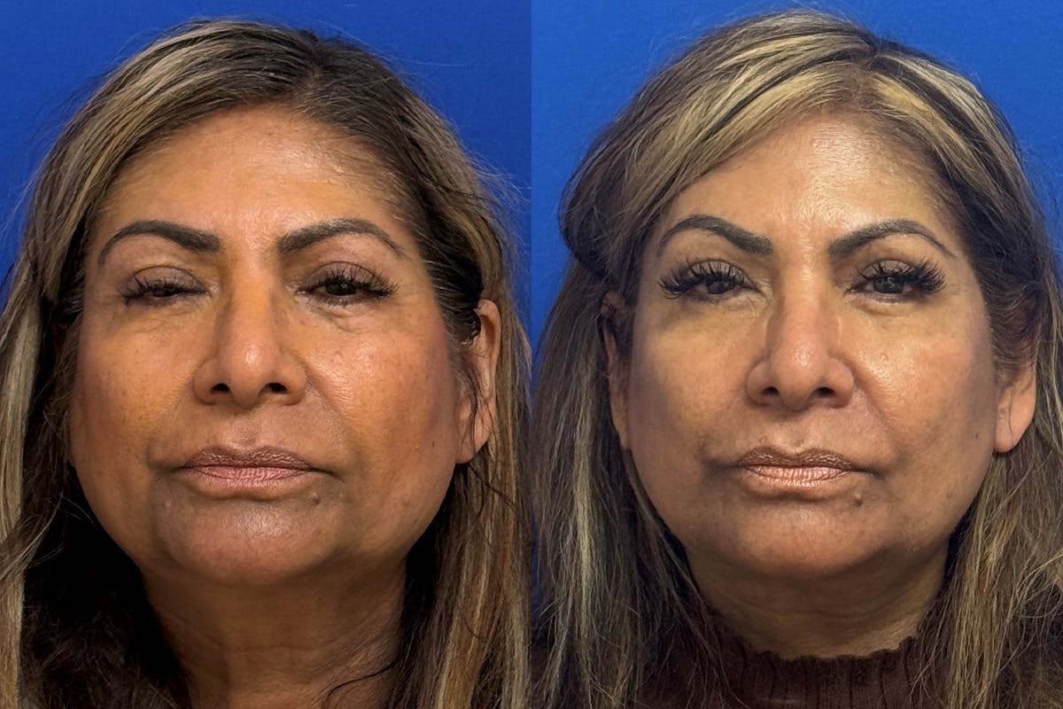 Neck Lift Before & After Gallery - Patient 154511 - Image 1