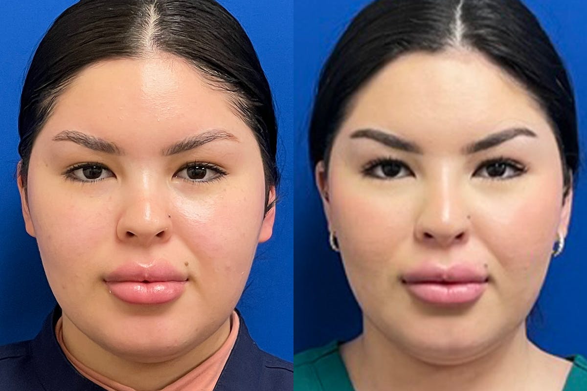 Dermal Filler Before & After Gallery - Patient 281579 - Image 3