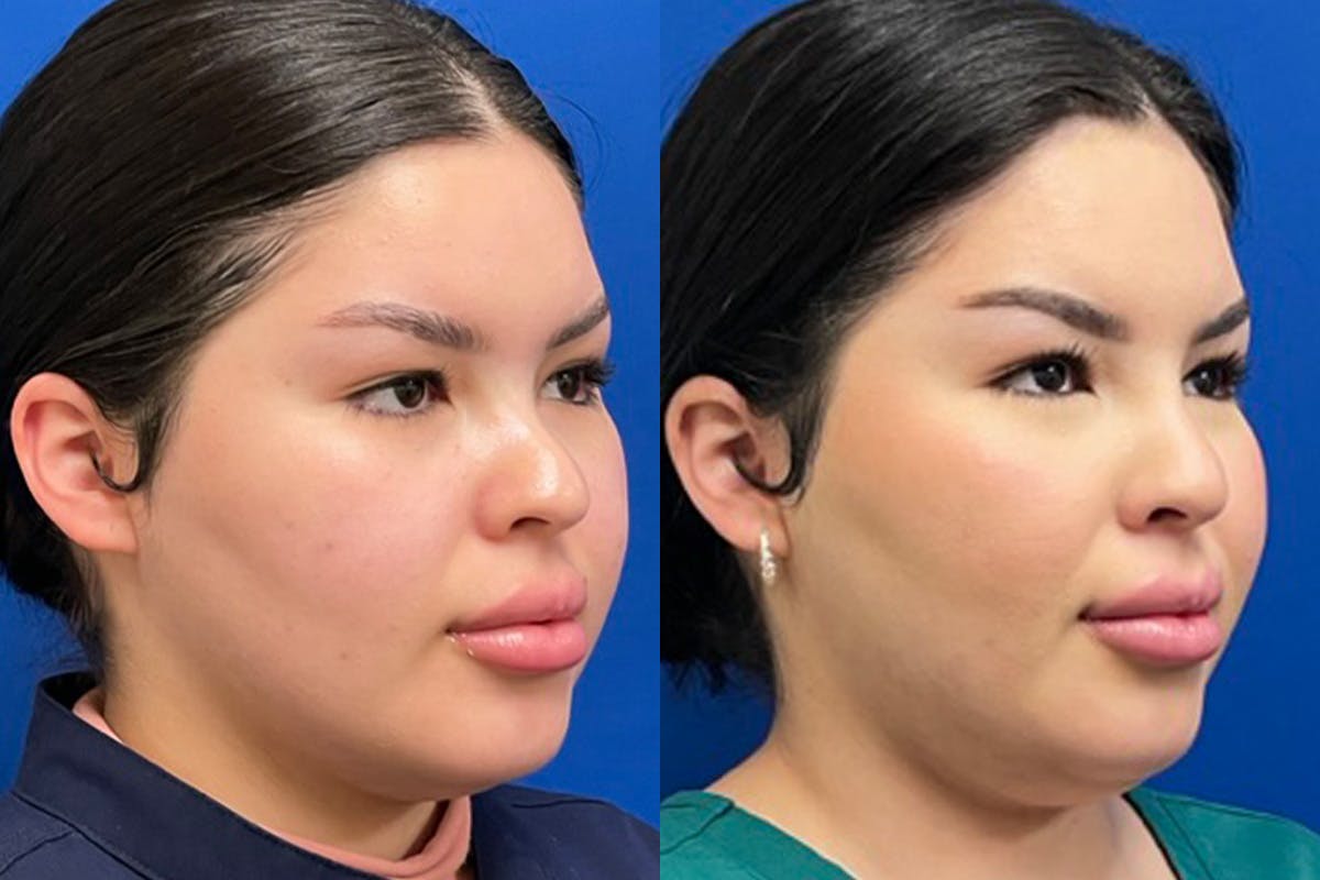 Dermal Filler Before & After Gallery - Patient 281579 - Image 2