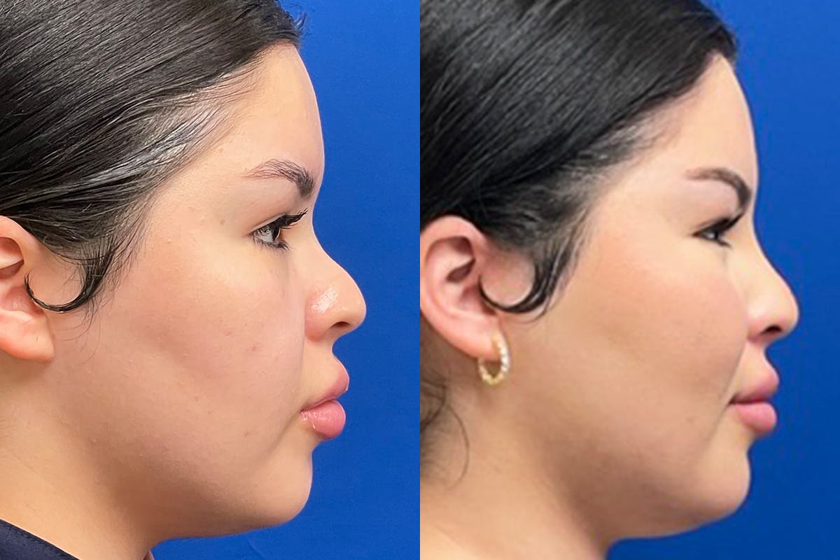 Dermal Filler Before & After Gallery - Patient 281579 - Image 1