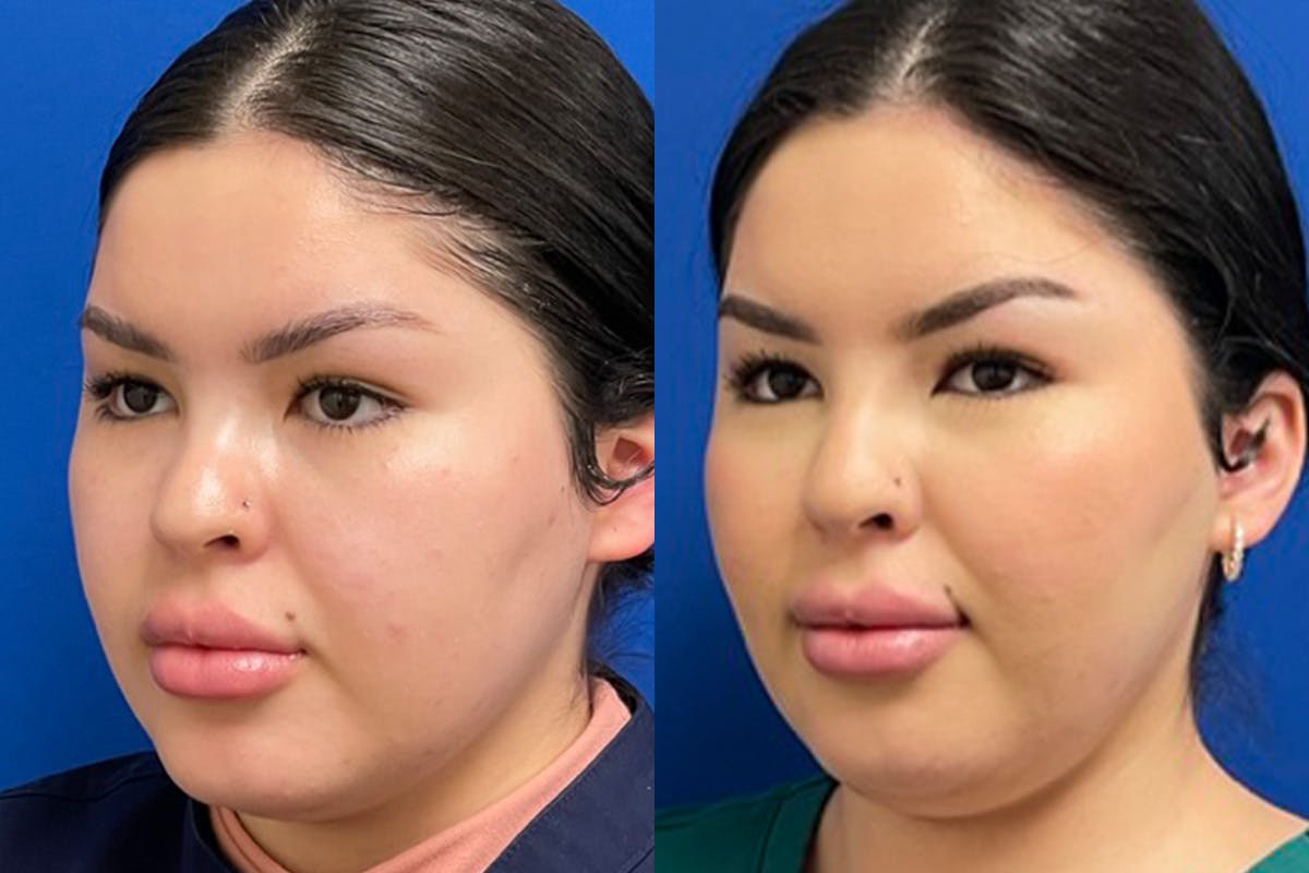 Dermal Filler Before & After Gallery - Patient 281579 - Image 4