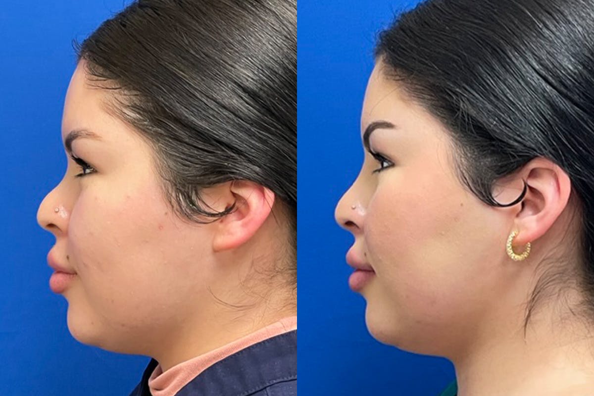 Dermal Filler Before & After Gallery - Patient 281579 - Image 5