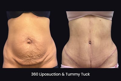 Abdominoplasty Before & After Gallery - Patient 296095 - Image 1
