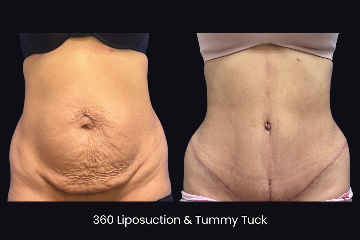 Abdominoplasty Before & After Gallery - Patient 296095 - Image 1